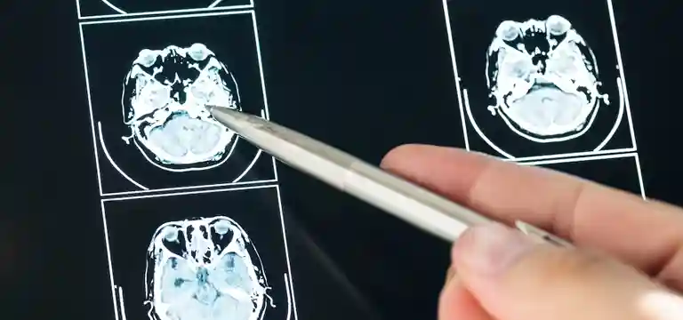 Role of Pet Scan in Diagnosing Cause of FUO and PUO